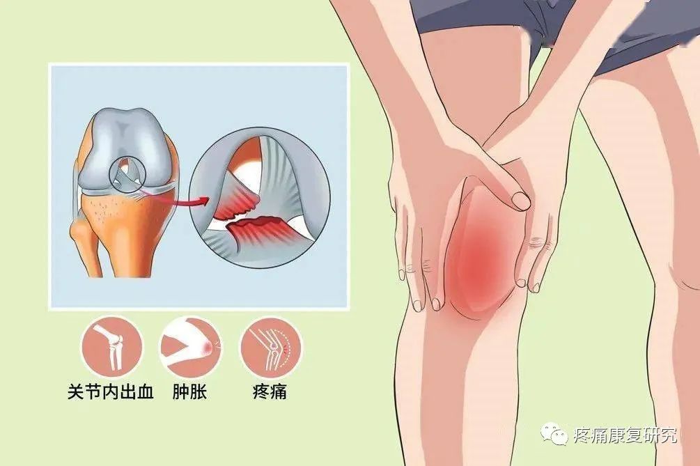 前交叉韧带损伤的相关解剖、分型、病因、症状、诊断和治疗