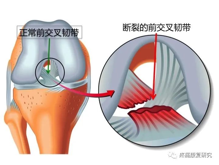 前交叉韧带损伤的相关解剖、分型、病因、症状、诊断和治疗