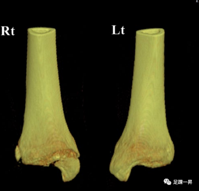 3D打印技术在复杂胫骨远端骨折和踝部撕脱骨折中的应用