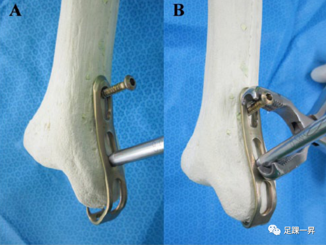 3D打印技术在复杂胫骨远端骨折和踝部撕脱骨折中的应用