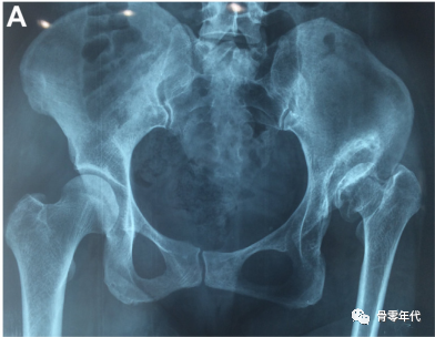 颗粒植骨解决大部分髋臼骨缺损超过30%的髋关节发育不良的髋关节置换