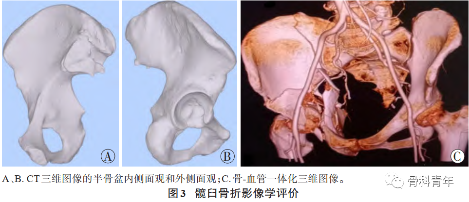 髋臼四边体骨折临床诊疗指南（2023版）