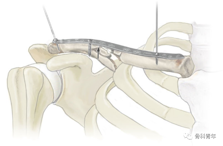 MIPPO技术治疗锁骨骨折的手术步骤及其相关问题