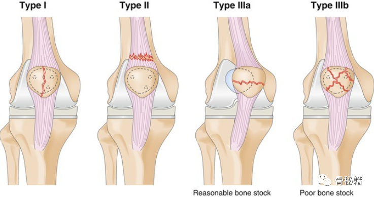 膝关节置换术后的髌骨骨折