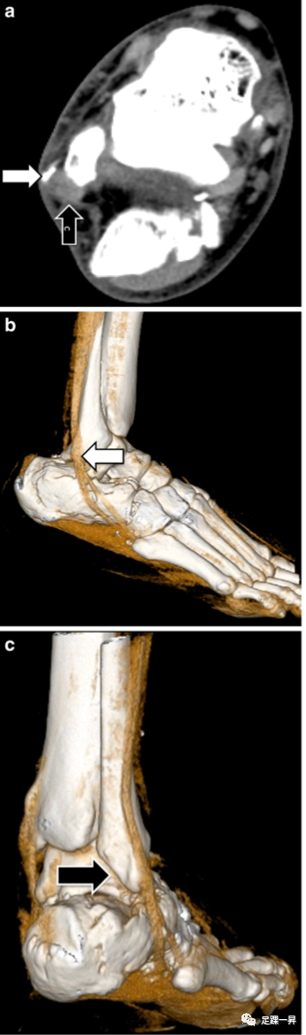 足踝部骨折脱位中的复位陷阱：肌腱卡压或嵌顿--续篇