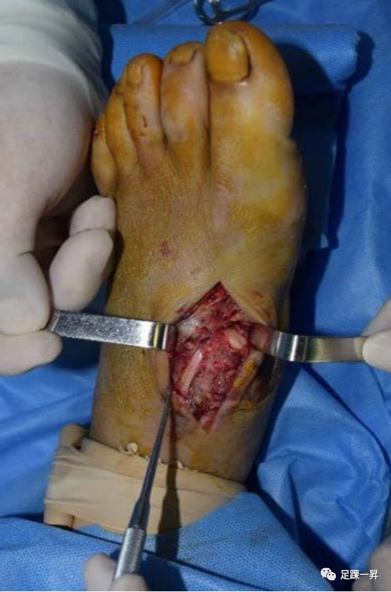 足踝部骨折脱位中的复位陷阱：肌腱卡压或嵌顿--续篇