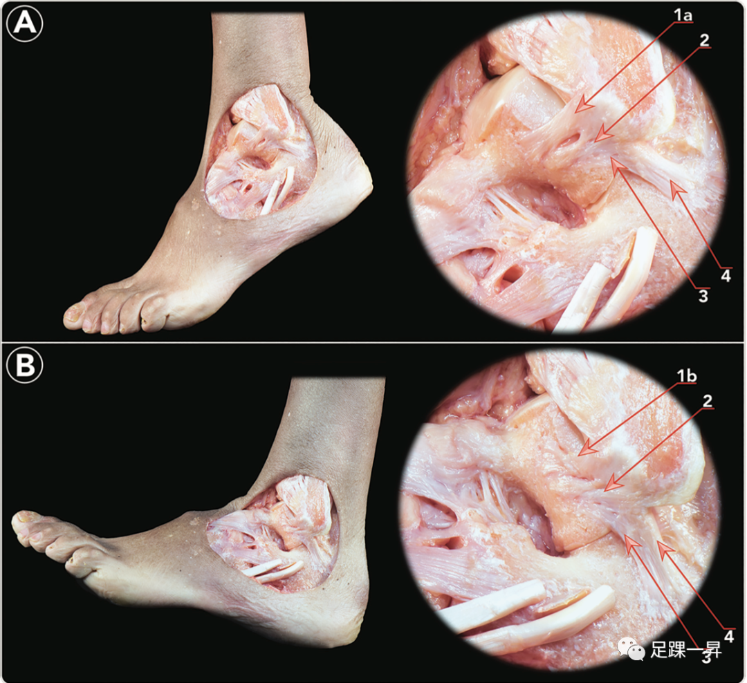 【足踝解剖】距腓前韧带上、下束的临床意义及功能