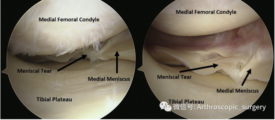 【手术技术】如何充分的暴露膝关节内侧间室？