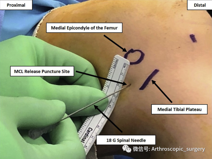 【手术技术】如何充分的暴露膝关节内侧间室？
