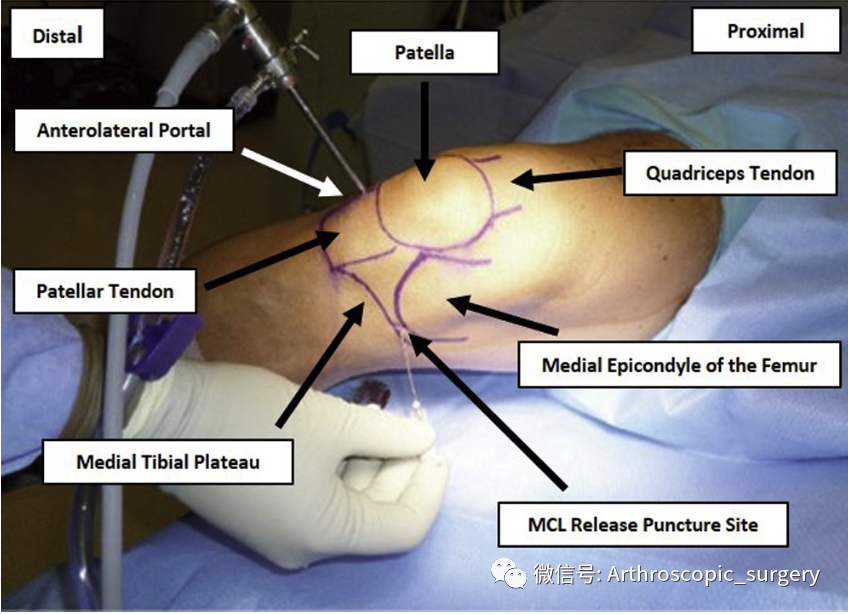 【手术技术】如何充分的暴露膝关节内侧间室？