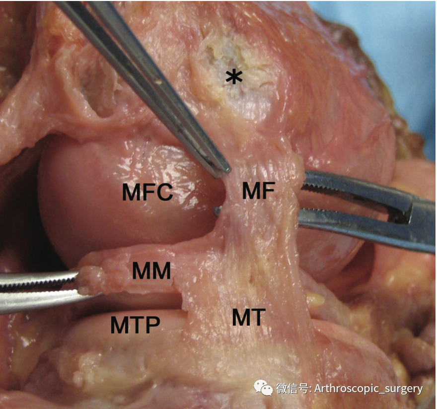 【手术技术】如何充分的暴露膝关节内侧间室？