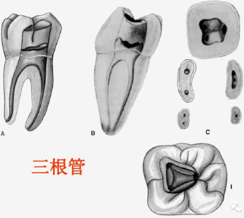 盘点磨牙开髓的方法