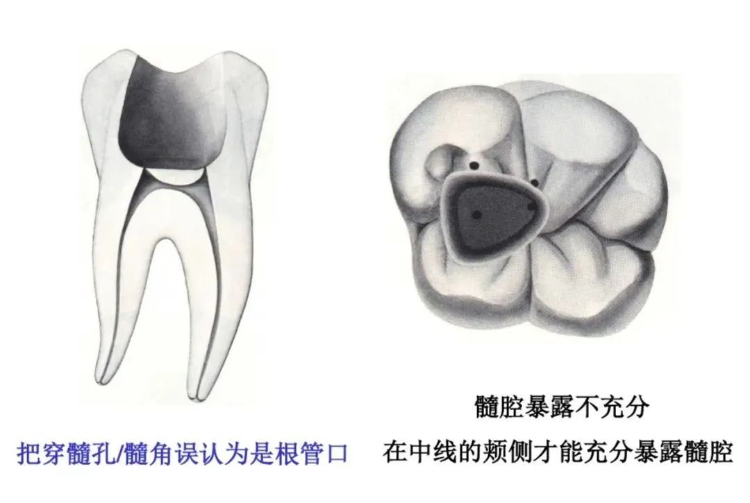 盘点磨牙开髓的方法