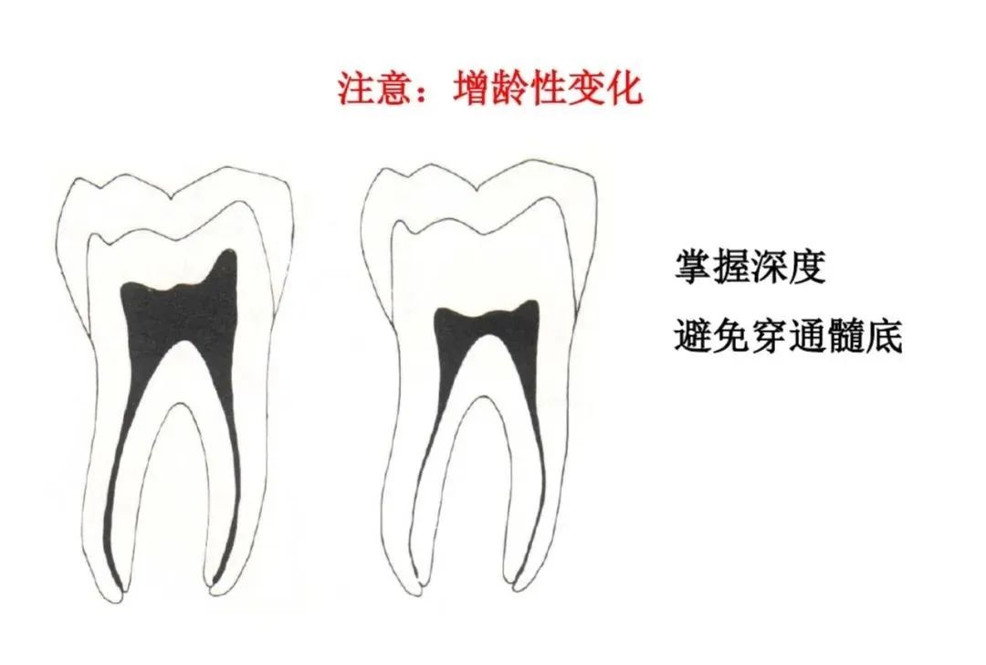 盘点磨牙开髓的方法