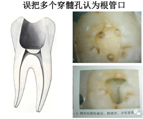 盘点磨牙开髓的方法