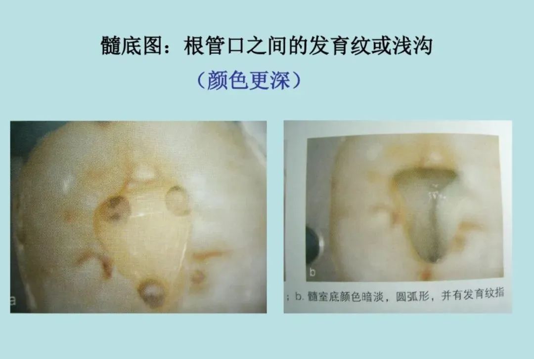 盘点磨牙开髓的方法