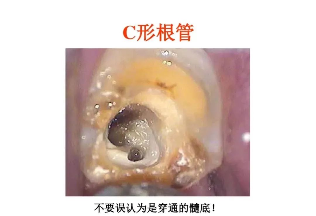 盘点磨牙开髓的方法