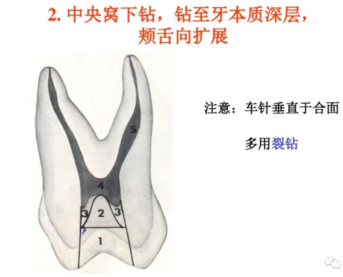 盘点磨牙开髓的方法