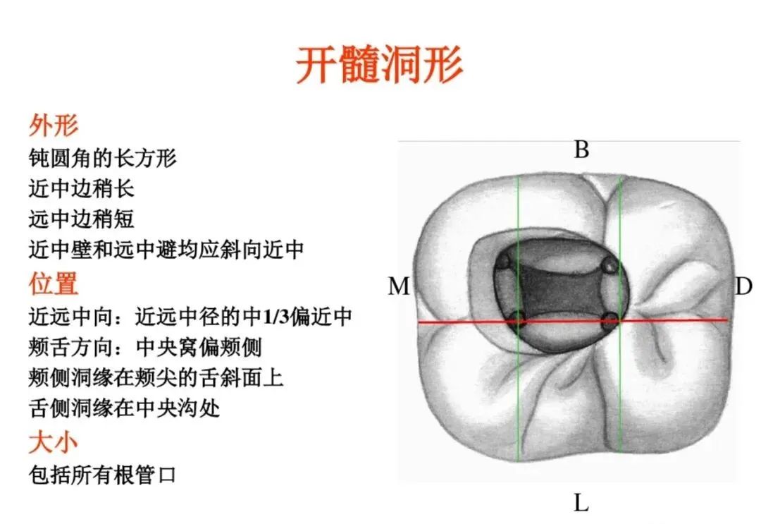 盘点磨牙开髓的方法