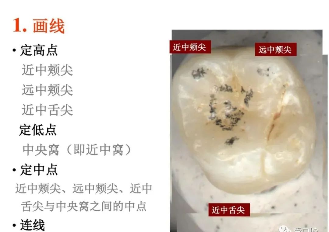 盘点磨牙开髓的方法