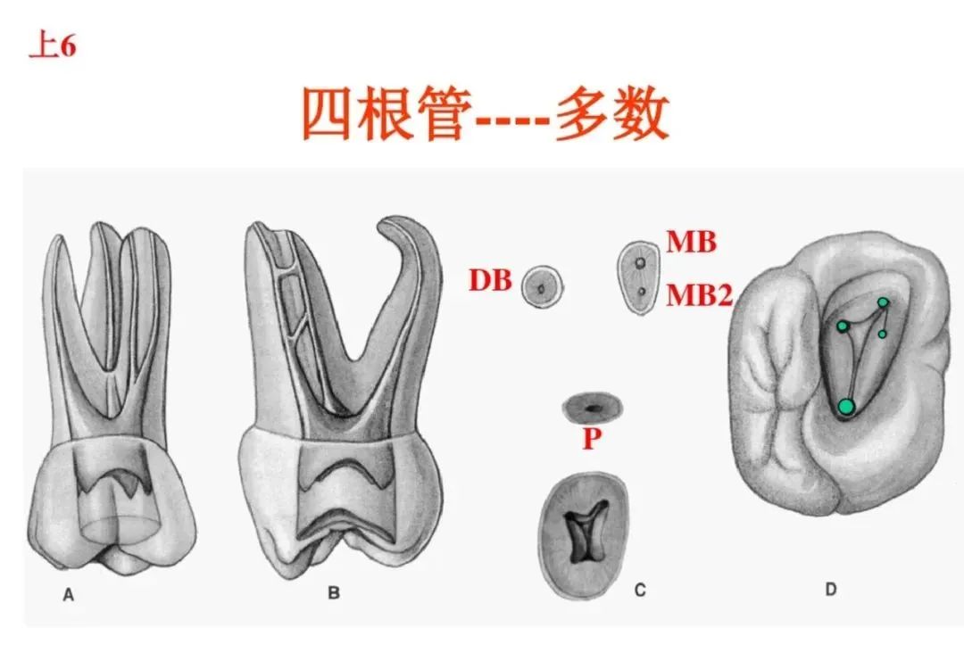 盘点磨牙开髓的方法