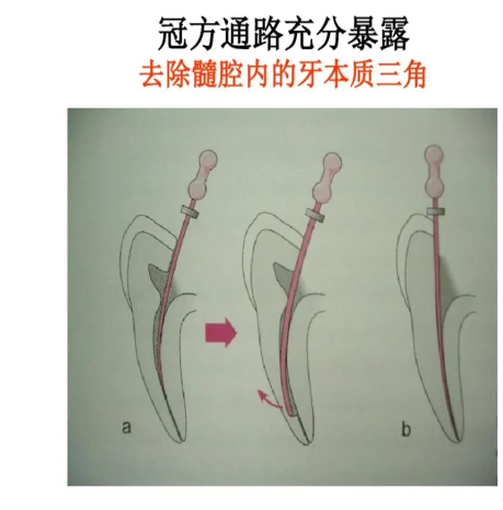 盘点磨牙开髓的方法