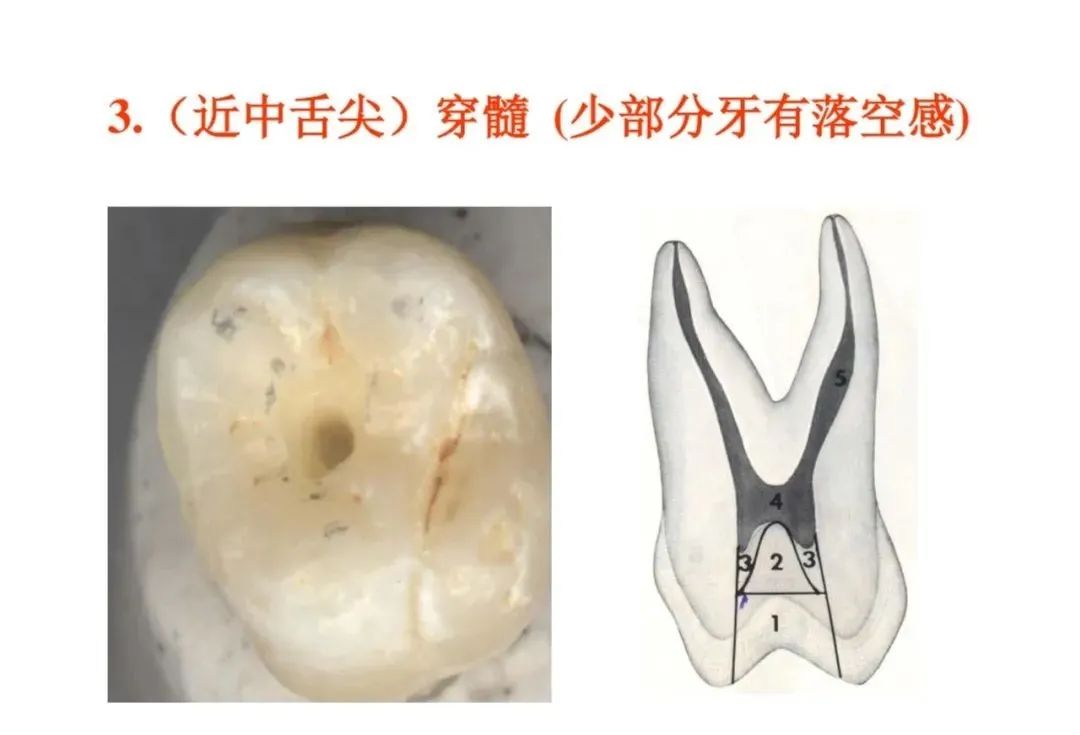 盘点磨牙开髓的方法