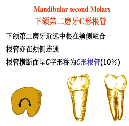 盘点磨牙开髓的方法