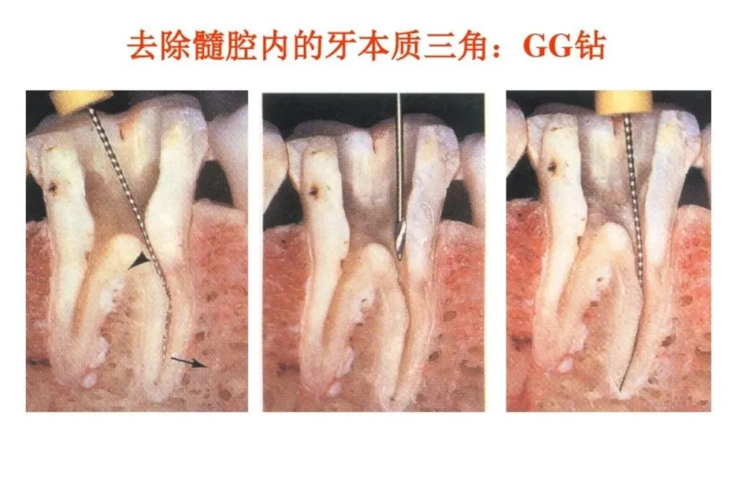 盘点磨牙开髓的方法