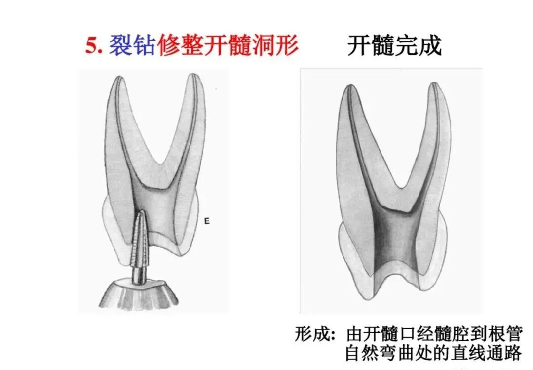 盘点磨牙开髓的方法