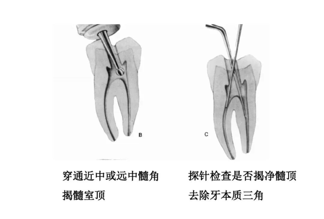 盘点磨牙开髓的方法