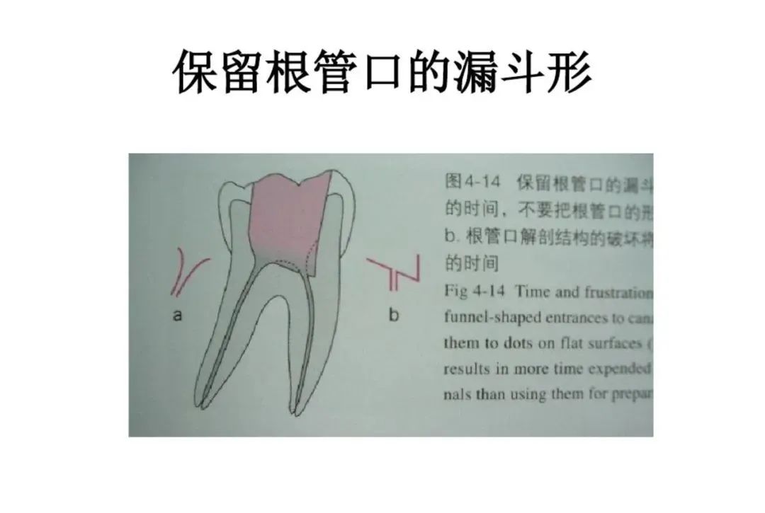 盘点磨牙开髓的方法