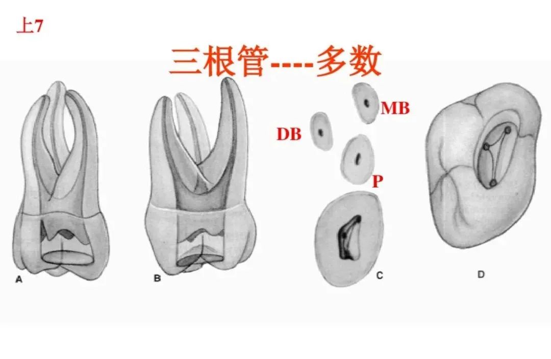 盘点磨牙开髓的方法