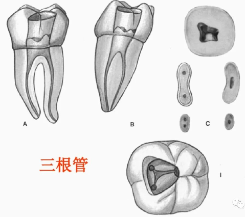 盘点磨牙开髓的方法