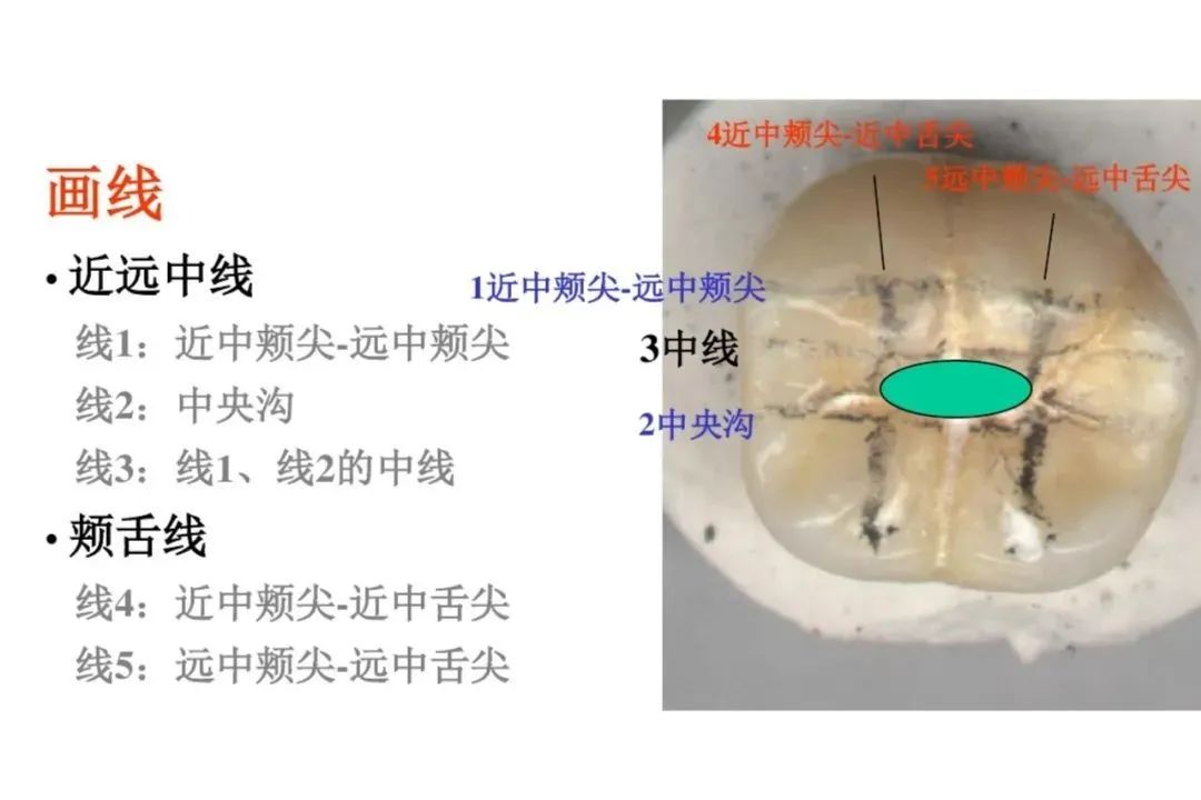 盘点磨牙开髓的方法