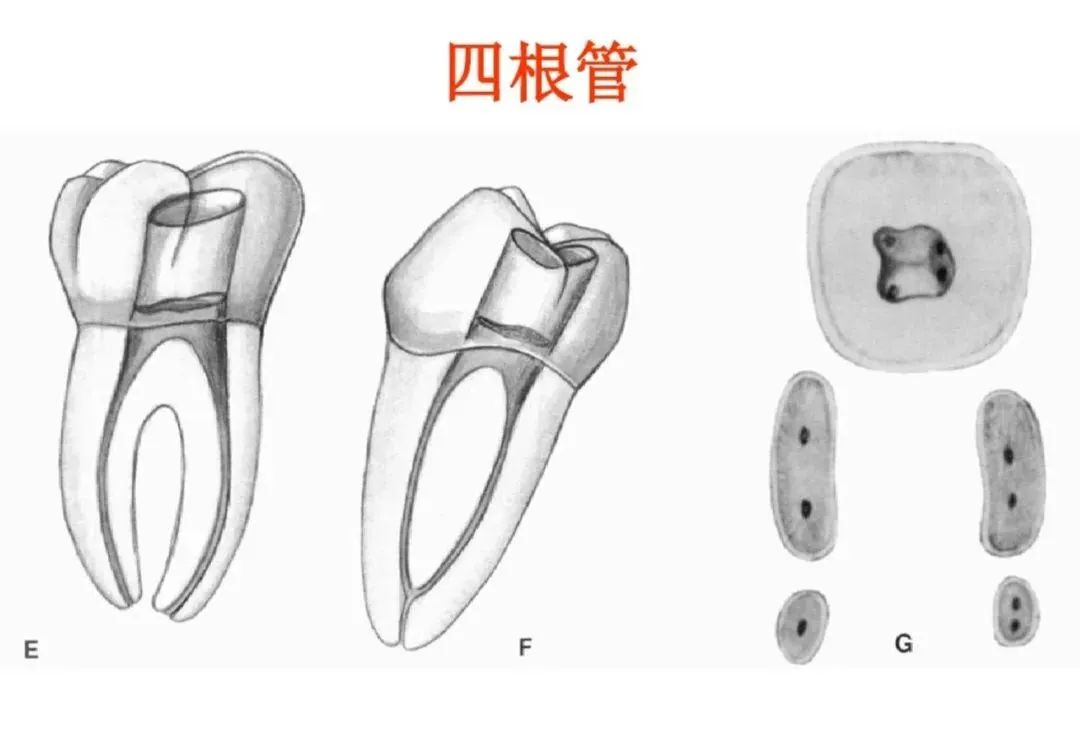 盘点磨牙开髓的方法