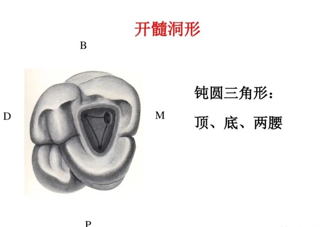 盘点磨牙开髓的方法