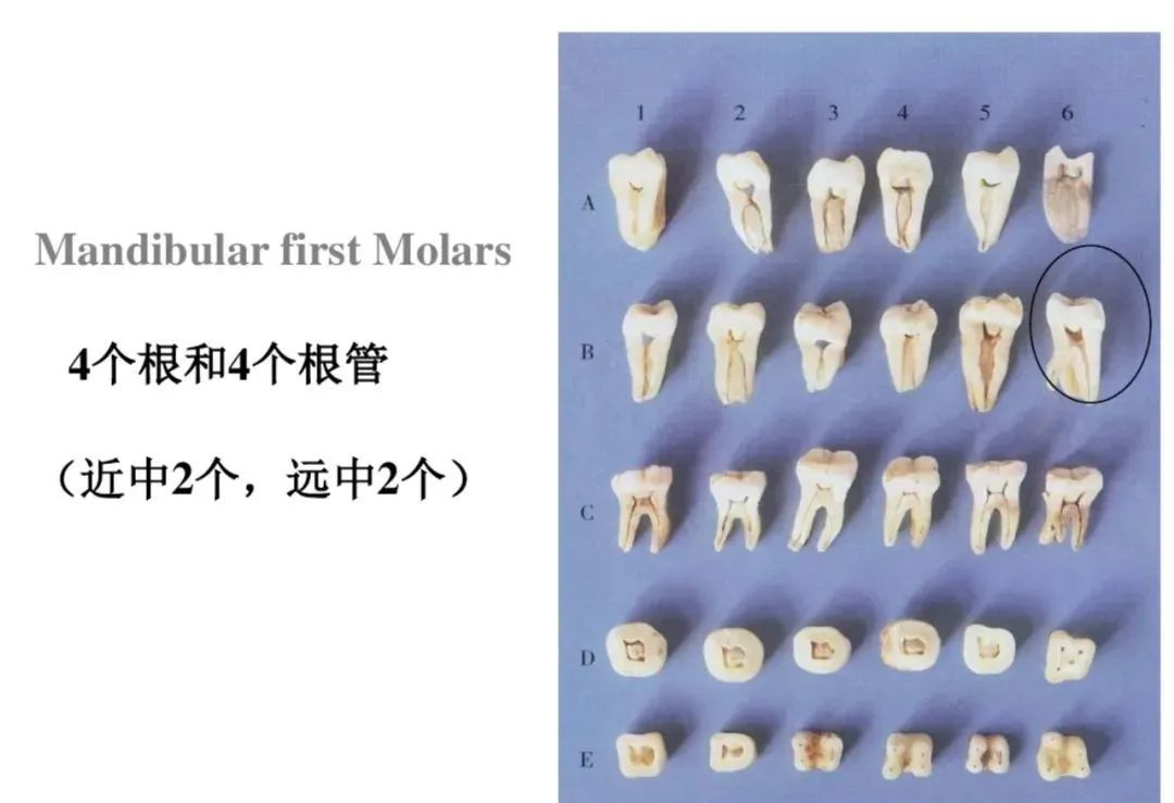 盘点磨牙开髓的方法