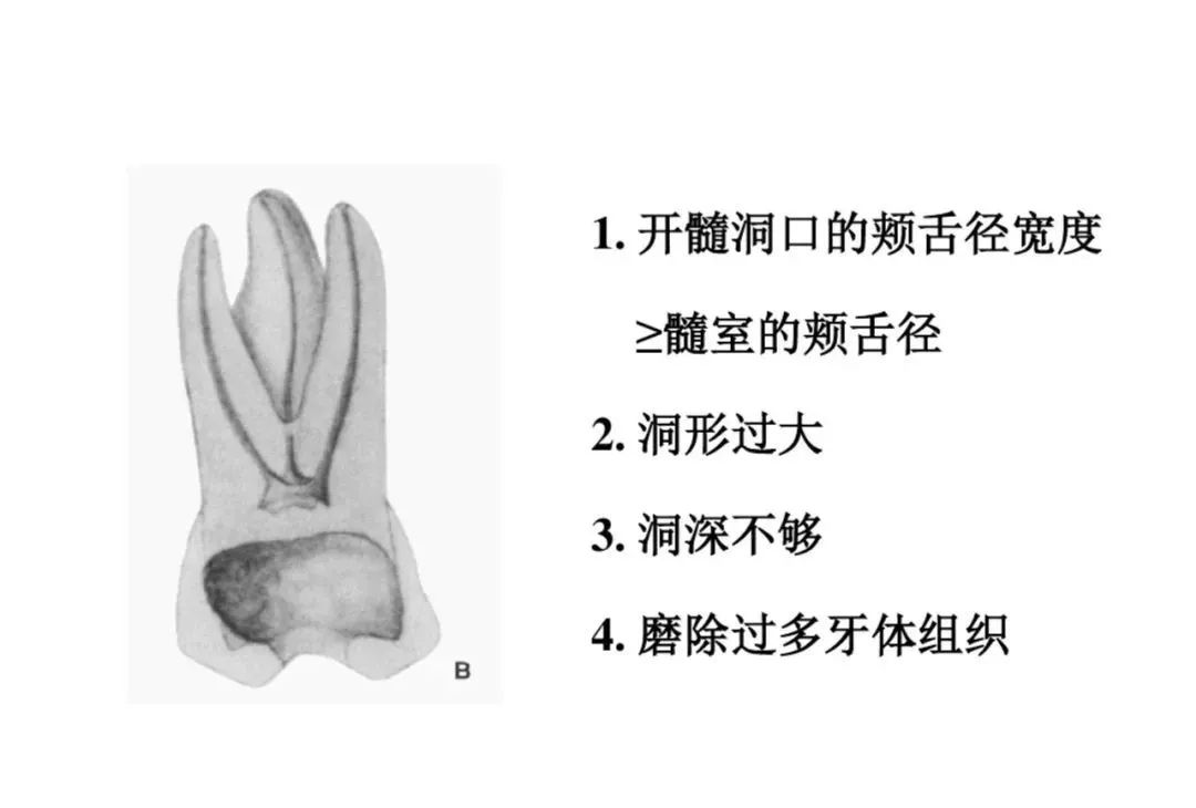 盘点磨牙开髓的方法