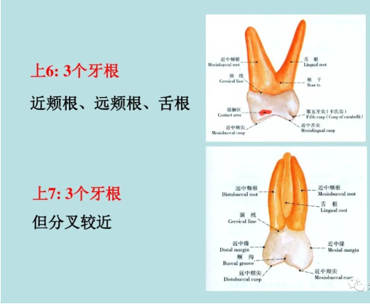 盘点磨牙开髓的方法