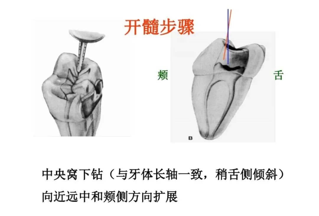 盘点磨牙开髓的方法