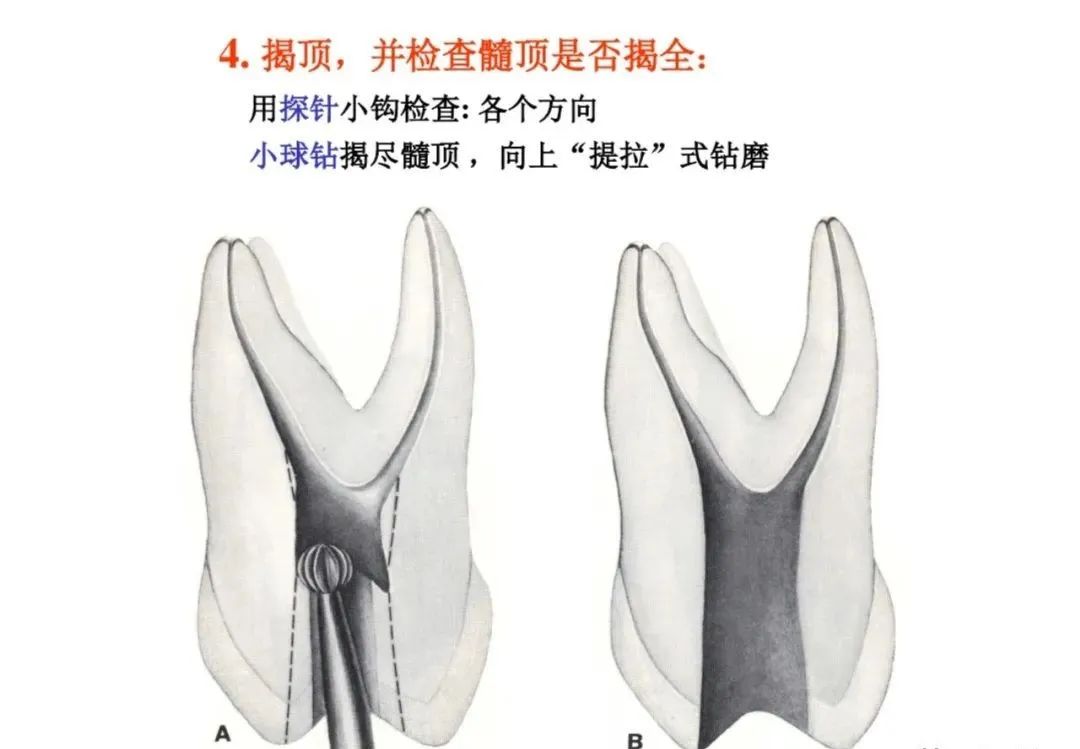 盘点磨牙开髓的方法