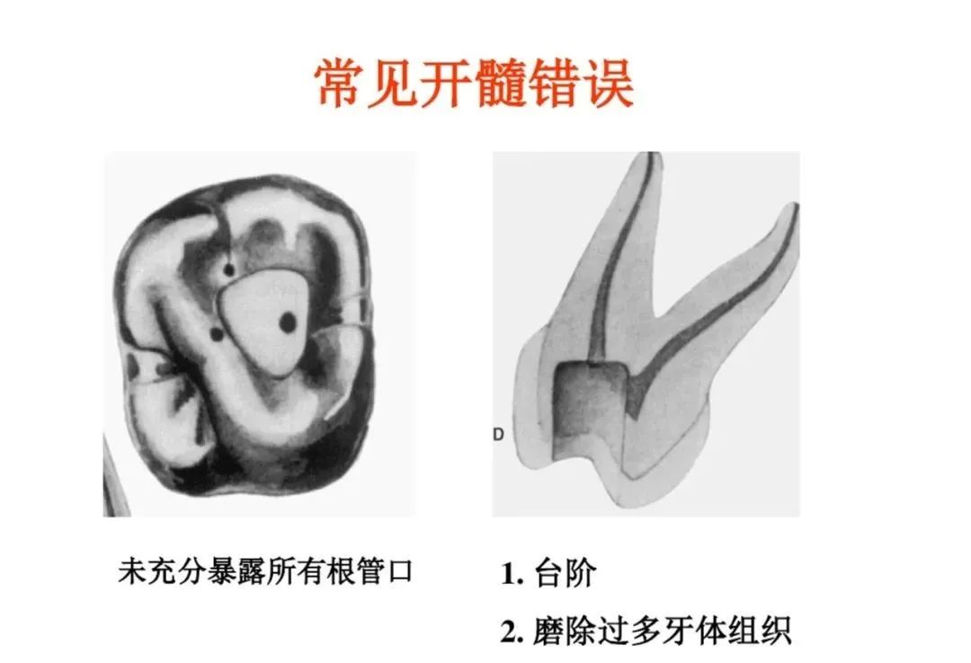 盘点磨牙开髓的方法