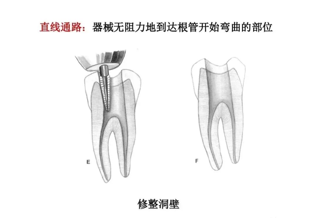 盘点磨牙开髓的方法