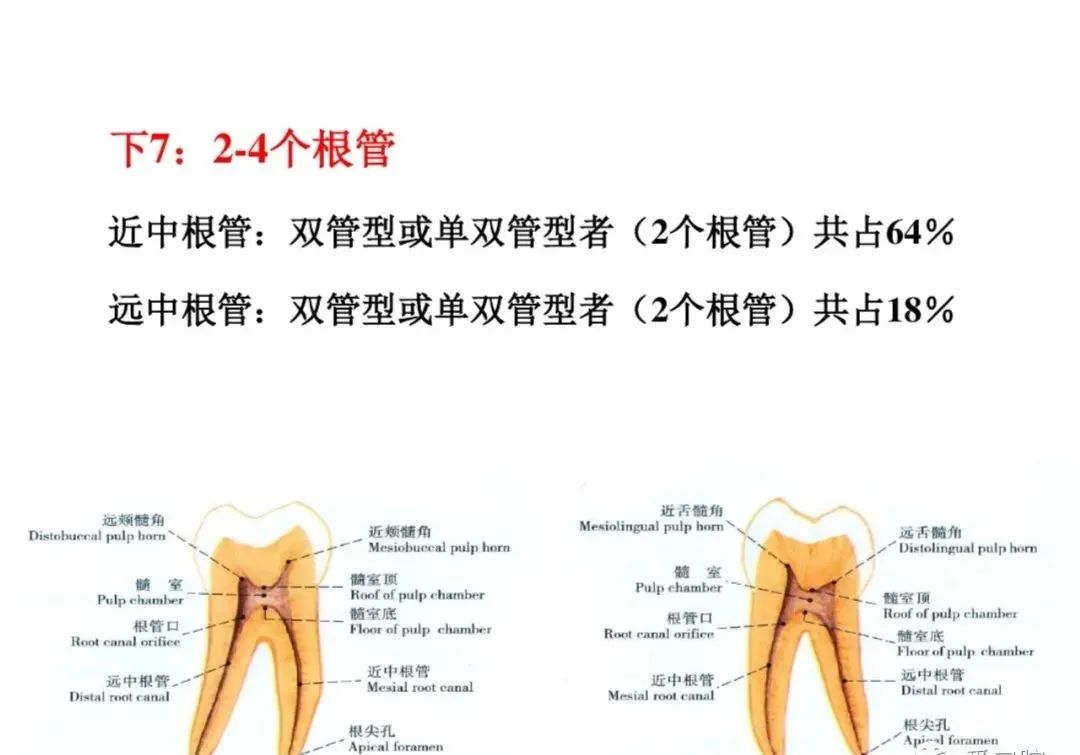 盘点磨牙开髓的方法