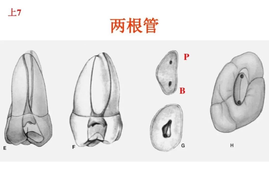 盘点磨牙开髓的方法