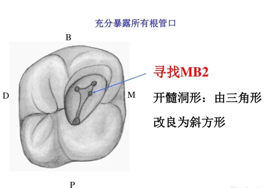 盘点磨牙开髓的方法