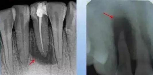 认识根尖周病的X片