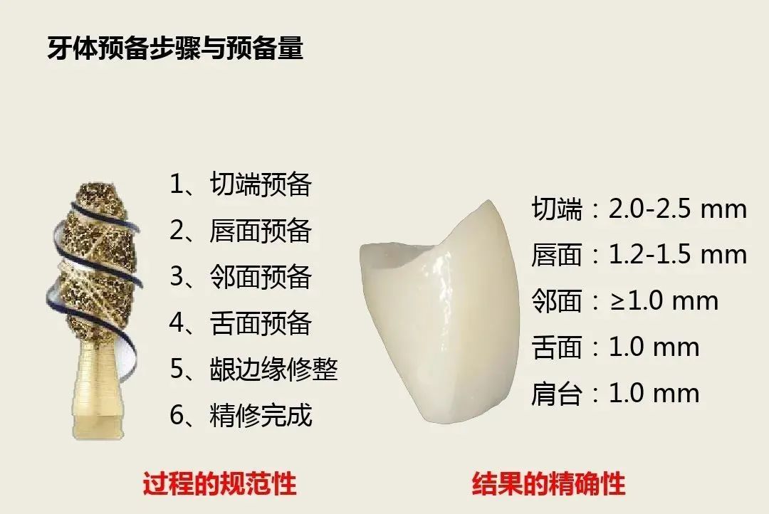 前牙全瓷冠的牙体预备