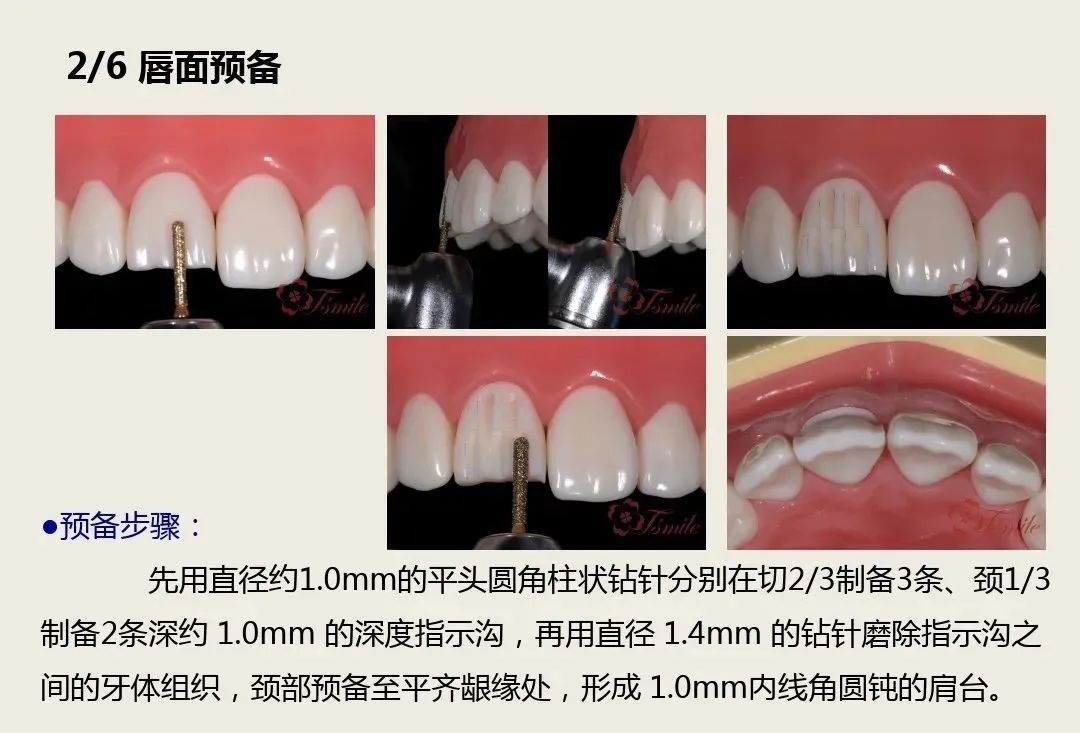 前牙全瓷冠的牙体预备